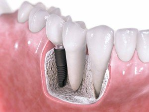 Dental-Implants-preston