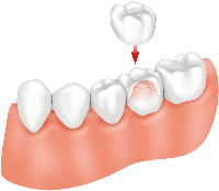 dental-crowns-preston